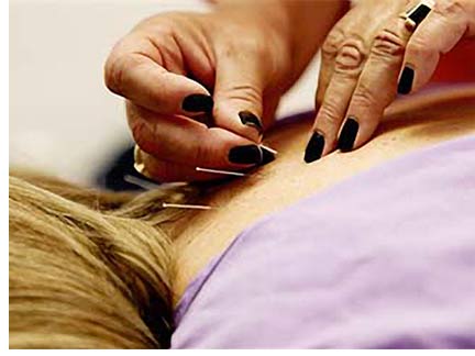 Acupunture Treatment