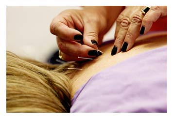 Acupuncture Treatment